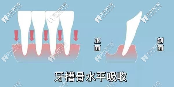 牙槽骨会慢慢吸收示意图