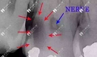 这是牙髓病变的图