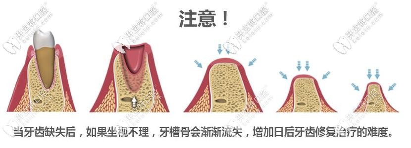 牙槽骨萎缩过程示意图