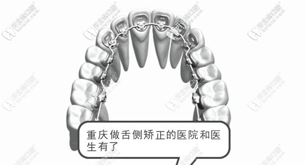 重庆哪家医院可以做牙齿舌侧矫正