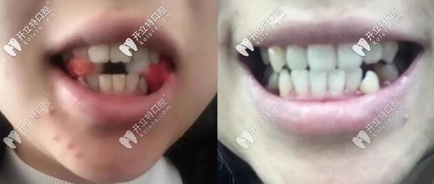 20多岁姑娘牙齿矫正之前的图片