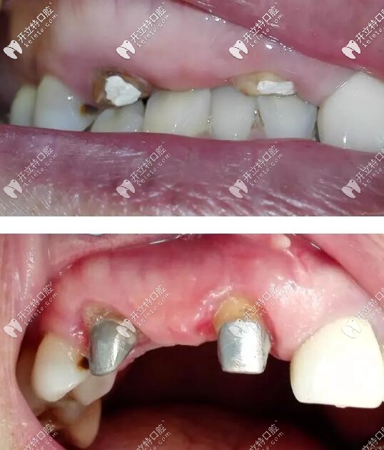 残牙根镶假牙案例 残牙根镶假牙案例