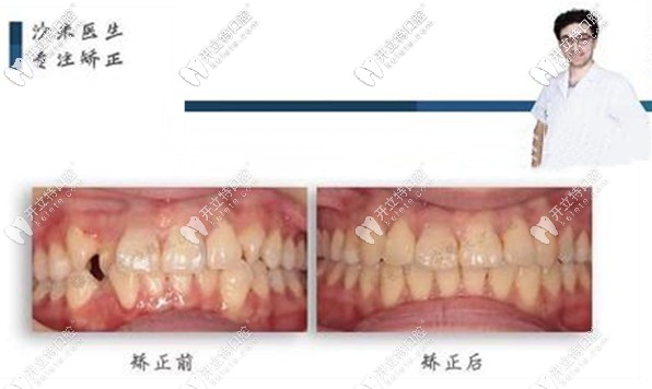 沙米医生矫正案例：牙齿不齐佩戴隐适美矫正器