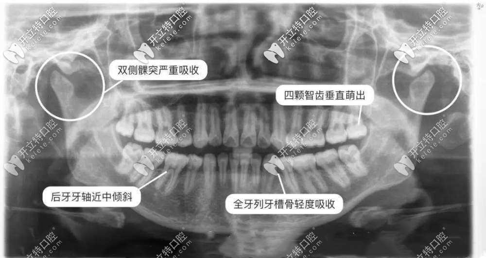 拔牙为啥要拍片？