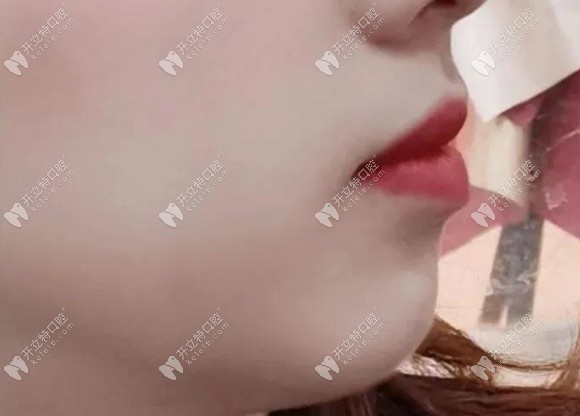 矫正龅牙后的侧面效果图 矫正龅牙后的侧面效果图