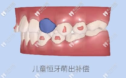 为儿牙萌出提供空间 为儿牙萌出提供空间