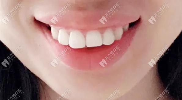 矫正前的龅牙齿图片 矫正前的龅牙齿图片