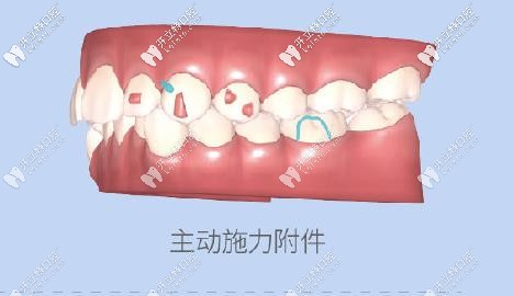 附件会对牙齿进行施力 附件会对牙齿进行施力