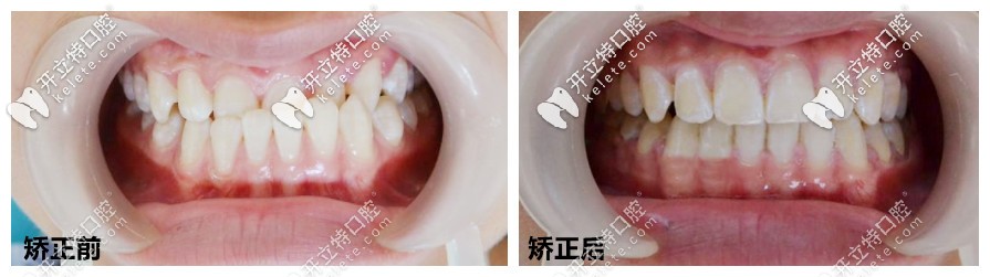 地包天矫正后的前后对比 地包天矫正后的前后对比