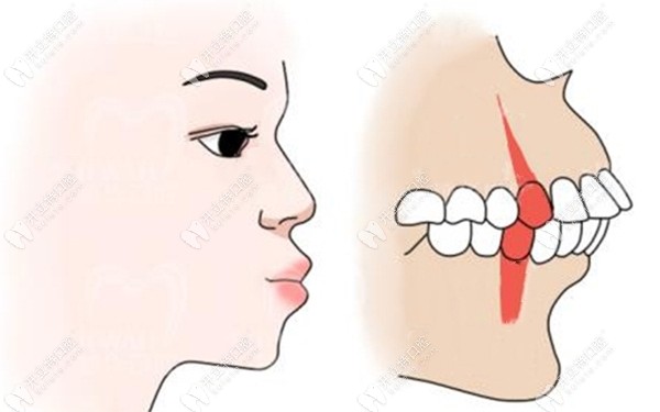 龅牙突嘴矫正前的卡通形象图