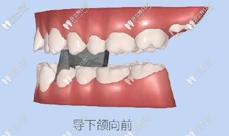 达芬奇牙套有效促进下颌骨发育 达芬奇牙套有效促进下颌骨发育