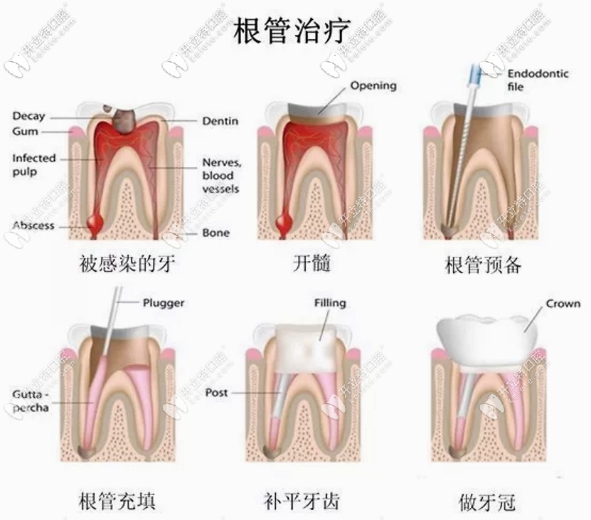 这是根管治疗步骤过程图解