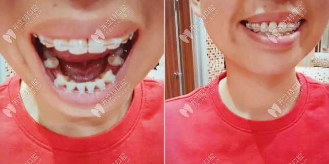 还在戴牙套中 还在戴牙套中