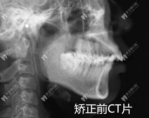 深覆合牙齿前突矫正前CT片