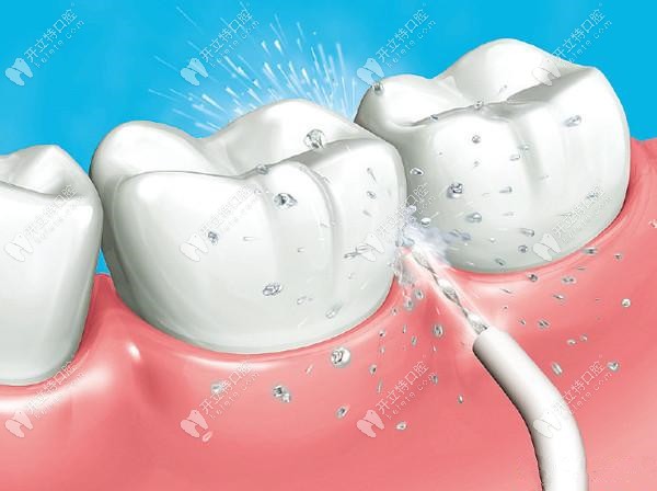 水激光不会对牙齿产生伤害