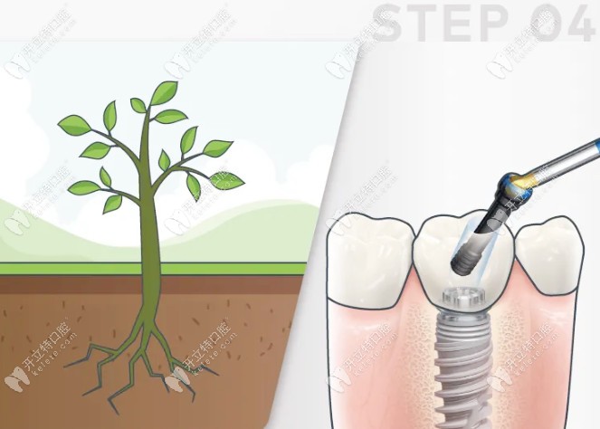 种树与种牙步骤详解