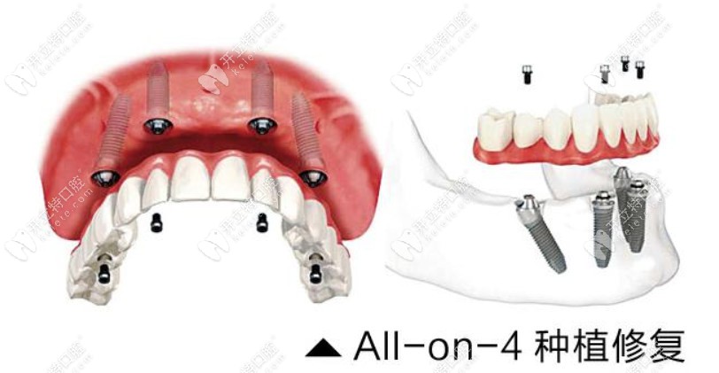 Allon4即刻种植牙技术