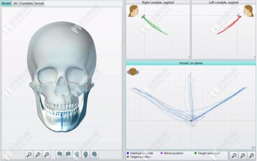 ZEBRIS电子面弓完整的颌运动测量流程