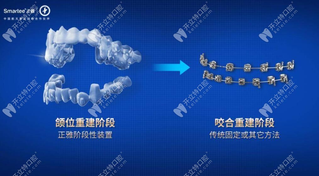 正雅S8S9颌位重建系列