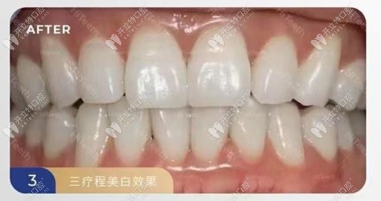 三个疗程后牙齿的样子