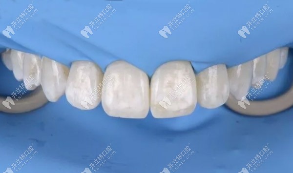 酸蚀渗透首先应使用牙间刷和预防性糊剂进行预防性抛光
