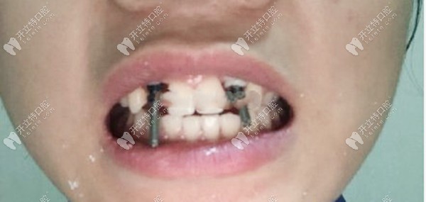 上颌两颗侧切牙缺失种植