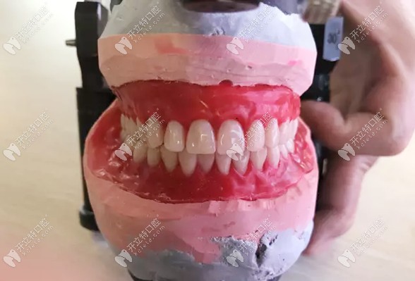 伊宁市李慧口腔的bps全口吸附性义齿修复,取模到使用仅需1天