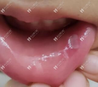 这5种症状的口腔溃疡别指望有立马见效的方法,赶紧看医生