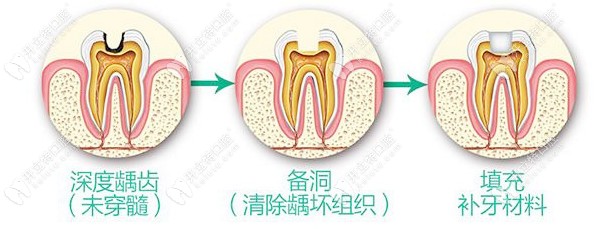 补牙简单流程