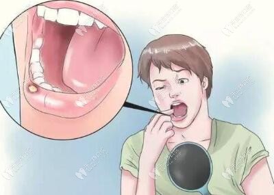 口腔溃疡症状