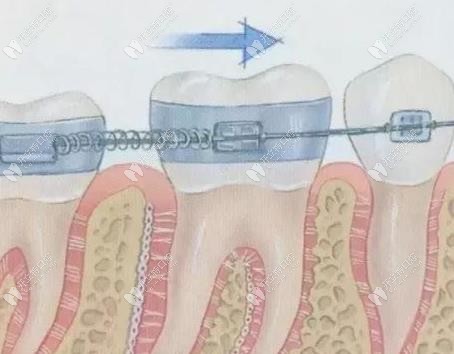 牙齿移动的过程