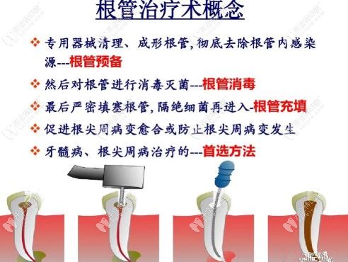 根管治疗的步骤