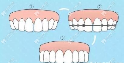 牙齿矫正步骤