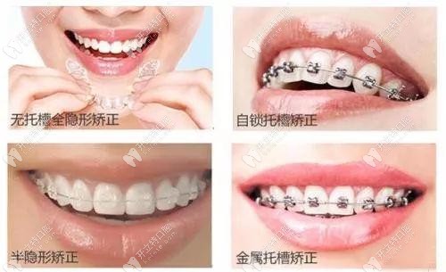 这是四种牙套的外观对比