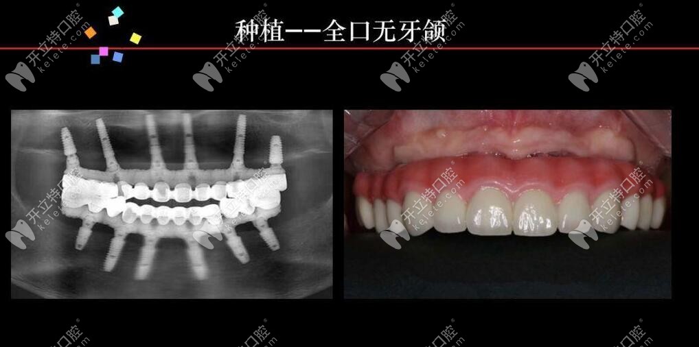 马龙桥全口种植修复