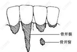好怕怕,矫正骨开窗开裂的人多吗?什么情况下容易骨开窗开裂