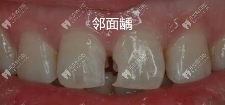 邻面龋