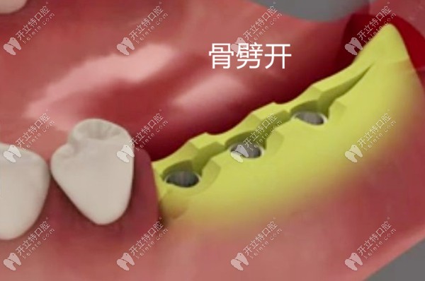 骨劈开术过程演示