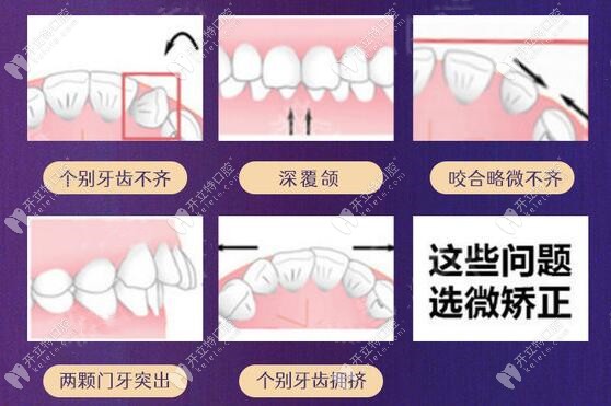 美加牙齿矫正的适应症状