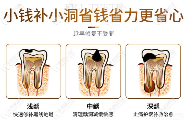 广州天河柏德口腔补牙优惠