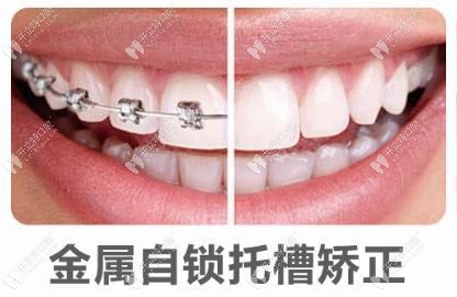 金属自锁托槽矫正外观