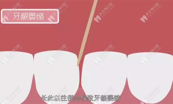 牙签会导致牙龈萎缩