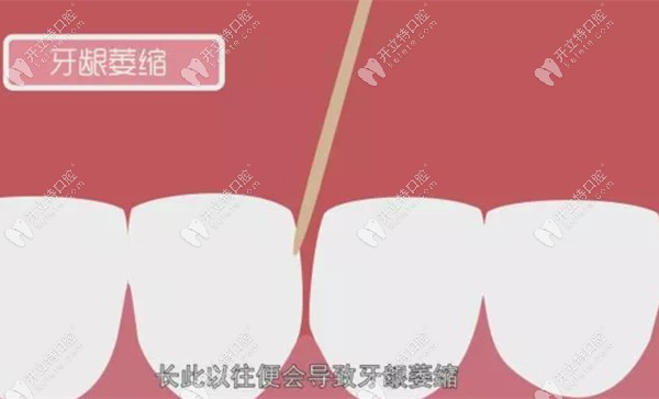 牙签会导致牙龈萎缩 牙签会导致牙龈萎缩