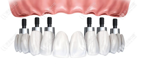 传统的种植牙技术时间比较长 传统的种植牙技术时间比较长