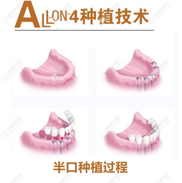在广州好大夫做ALL-on-4种植的过程图 在广州好大夫做ALL-on-4种植的过程图