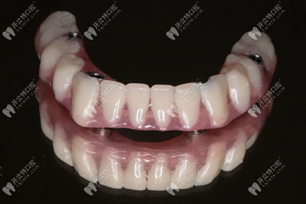 隔壁爷爷做的事ALL-on-4种植牙 隔壁爷爷做的事ALL-on-4种植牙