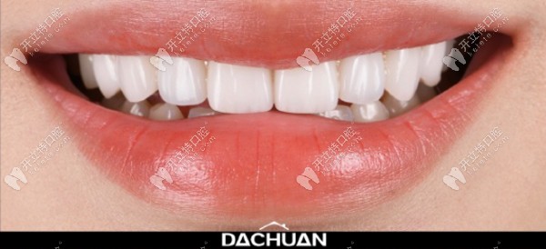 瓷贴面效果棒棒哒