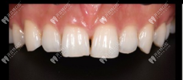 闺蜜门牙牙缝大