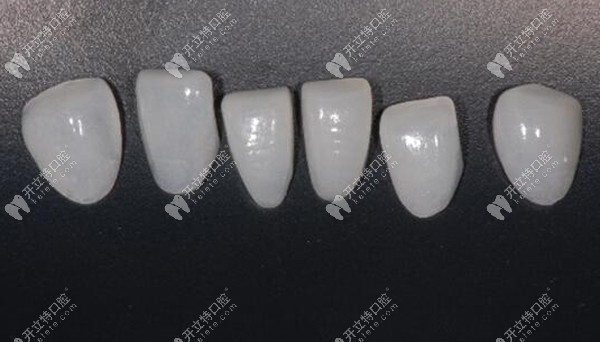 超薄全瓷牙贴面