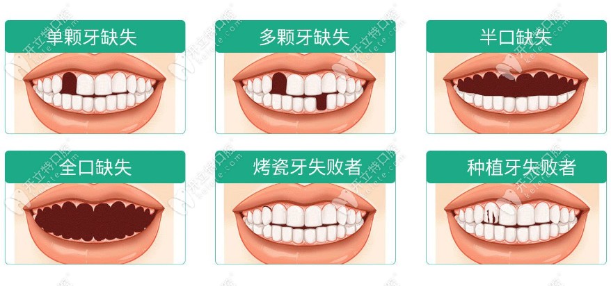 珠海九龙口腔韩国进口种植牙适应症